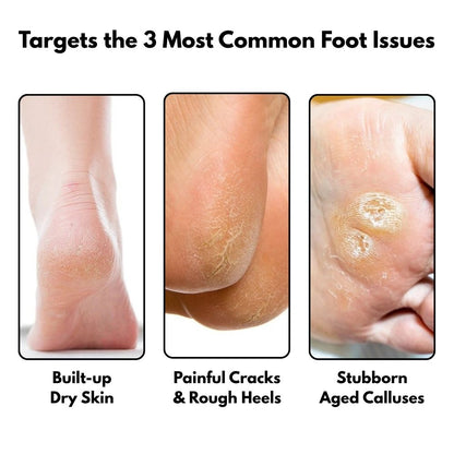 SilkySole Electric Callus Remover